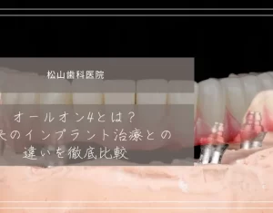 オールオン4とは？従来のインプラント治療との違いを徹底比較