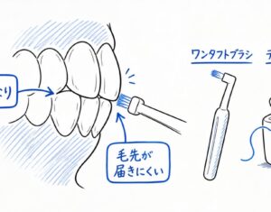 歯の重なりで届かない…歯周病を防ぐ磨き方とケア用品を解説