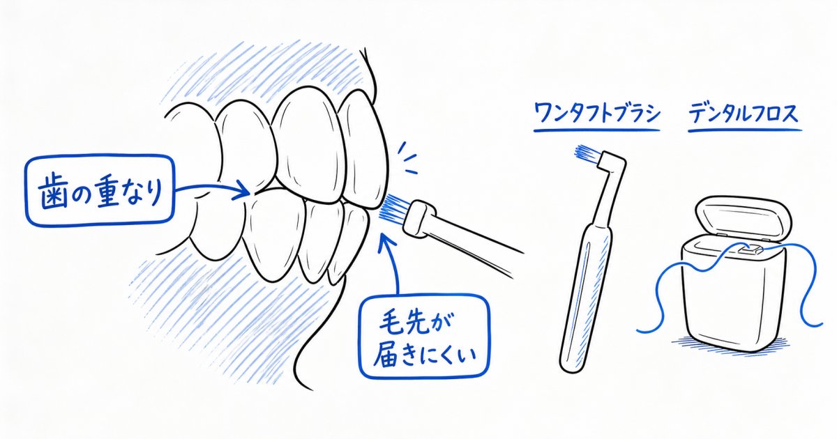 歯の重なりで届かない…歯周病を防ぐ磨き方とケア用品を解説